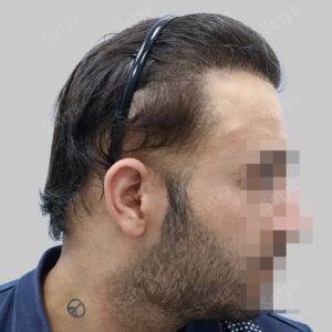 Hair Transplant for Men | before and after