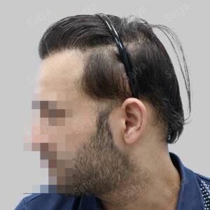Hair Transplant for Men | before and after