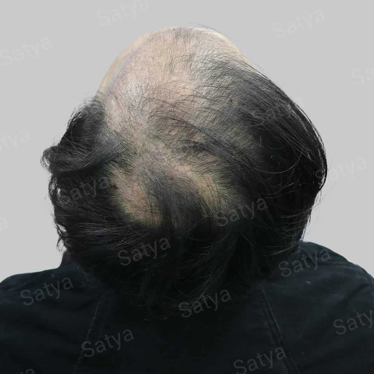 Hair Transplant Surgery Before and After Results Satya hair solutions
