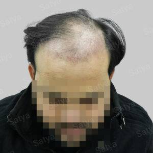 Hair Transplant Surgery Before and After Results Satya hair solutions