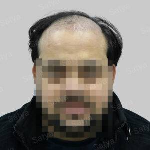 Hair Transplant Surgery Before and After Results Satya hair solutions