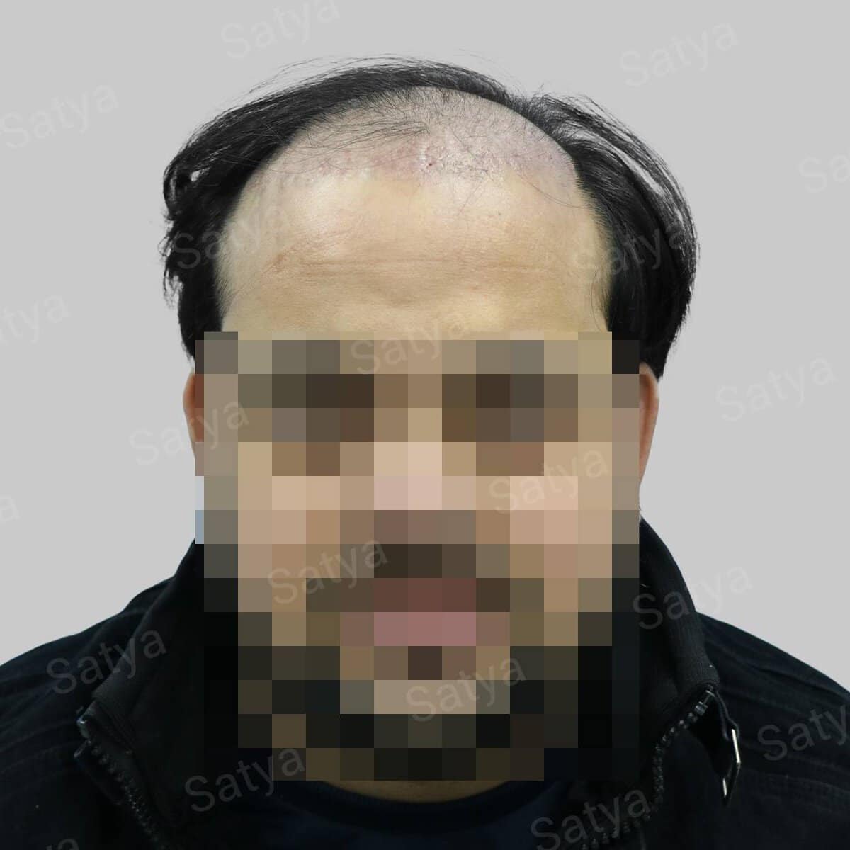 Shiva (7) Hair Transplant Surgery Before and After Results Satya hair solutions