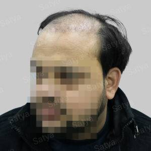 Hair Transplant Surgery Before and After Results Satya hair solutions