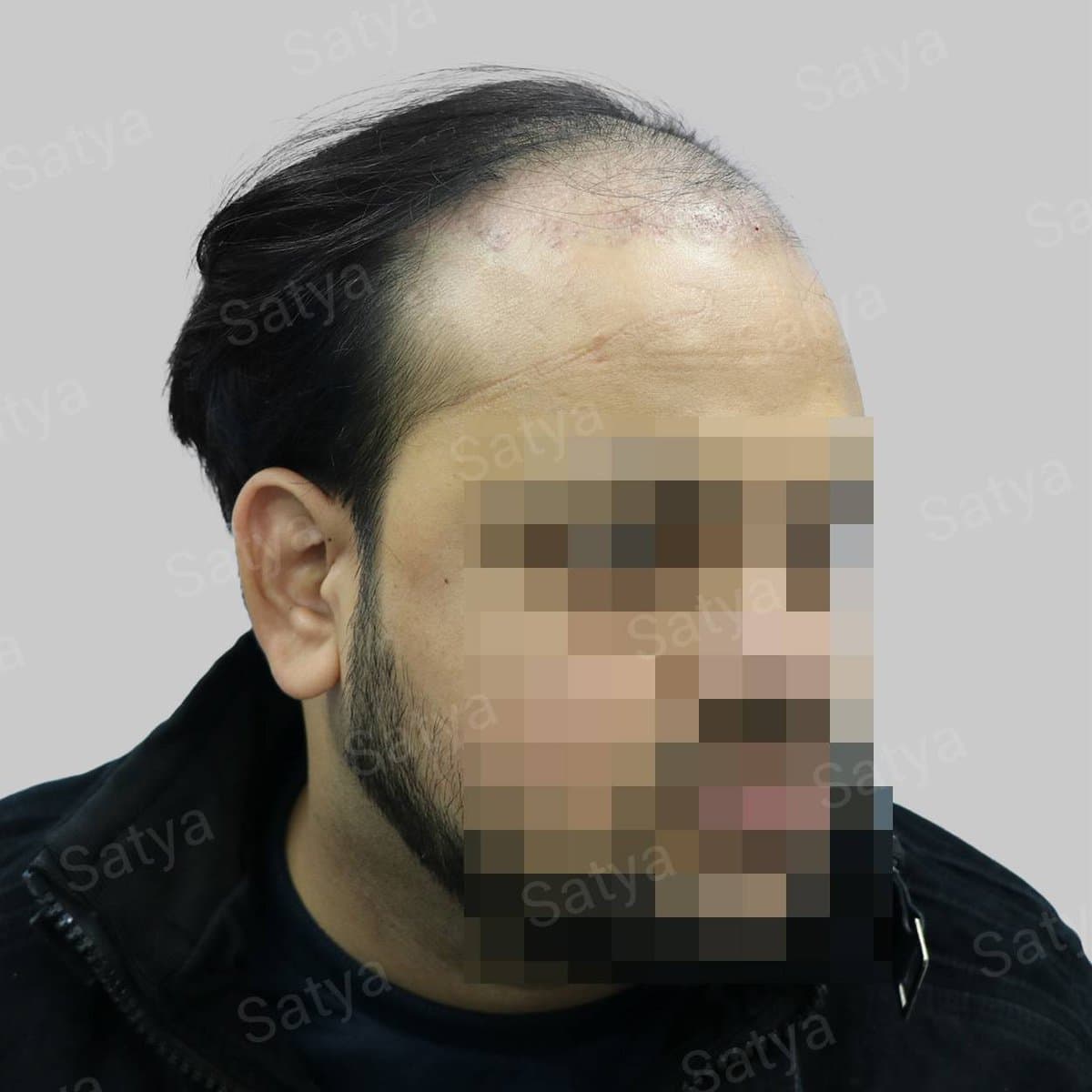 Hair Transplant Surgery Before and After Results Satya hair solutions