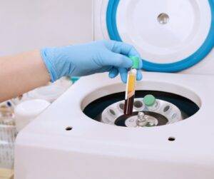 prp hair treatment