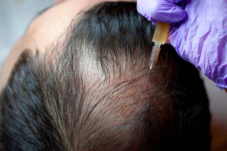 Things to Know About PRP in Hair Loss Treatment