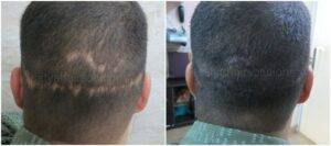 FUT Hair Transplant Technique