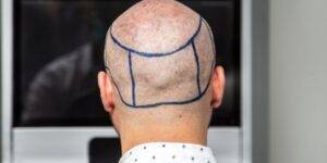 hair transplant from donor area