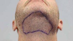 beard hair transplant