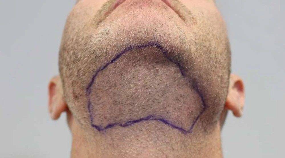 beard hair transplant
