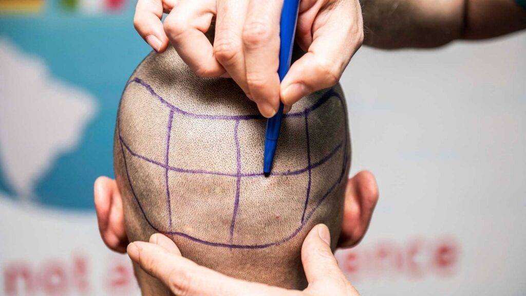 hair transplant from donor area