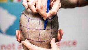 hair transplant from donor area