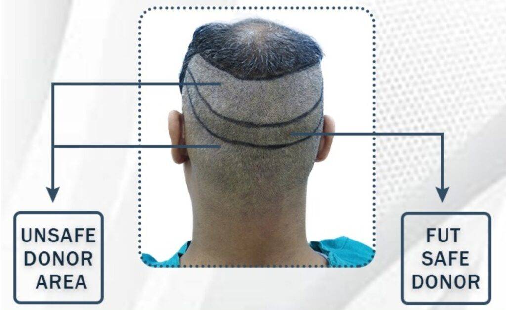 hair transplant from donor area