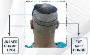 hair transplant from donor area