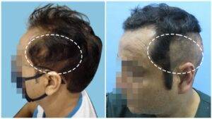 hair transplant result