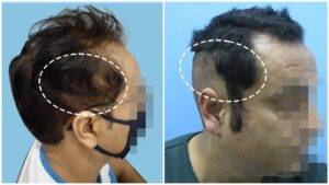 hair transplant result