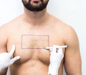 body hair transplant