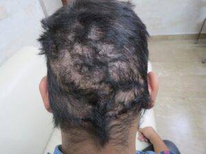 Fue hair transplant