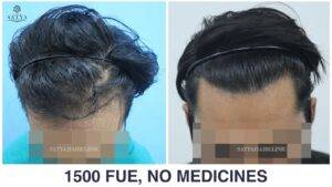 low hairline