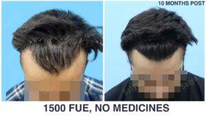 low hairline