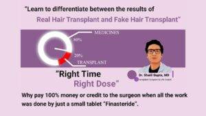 real or fake hair transplant