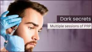 Things to Know About PRP in Hair Loss Treatment