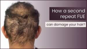 How a second repeat FUE can damage your hair?