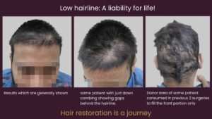 hair restoration