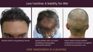 hair restoration