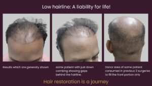 hair restoration
