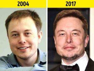 elon musk hair transplant