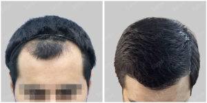 hair transplant results before and after