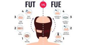 FUE Vs FUT