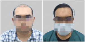 Men Hair Transplants: Satya hair Solutions