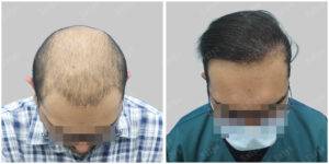 Men Hair Transplants: Satya hair Solutions