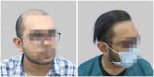 Men Hair Transplants: Satya hair Solutions