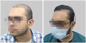 Men Hair Transplants: Satya hair Solutions