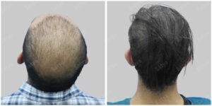 Men Hair Transplants: Satya hair Solutions