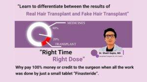 real and fake hair transplant