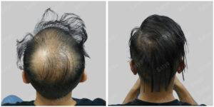 Men Hair Transplants: Satya hair Solutions