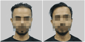 Men Hair Transplants: Satya hair Solutions