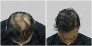 Men Hair Transplants: Satya hair Solutions