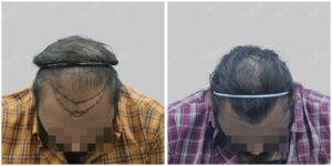 Men Hair Transplants: Satya hair Solutions