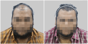 Men Hair Transplants: Satya hair Solutions