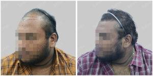 Men Hair Transplants: Satya hair Solutions
