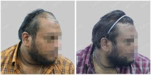 Men Hair Transplants: Satya hair Solutions