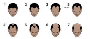 Male Pattern Baldness