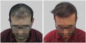 Men Hair Transplants: Satya hair Solutions