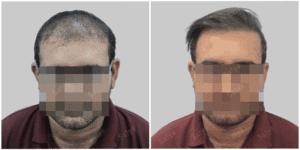 Men Hair Transplants: Satya hair Solutions