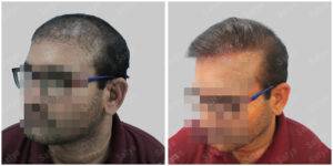 Men Hair Transplants: Satya hair Solutions